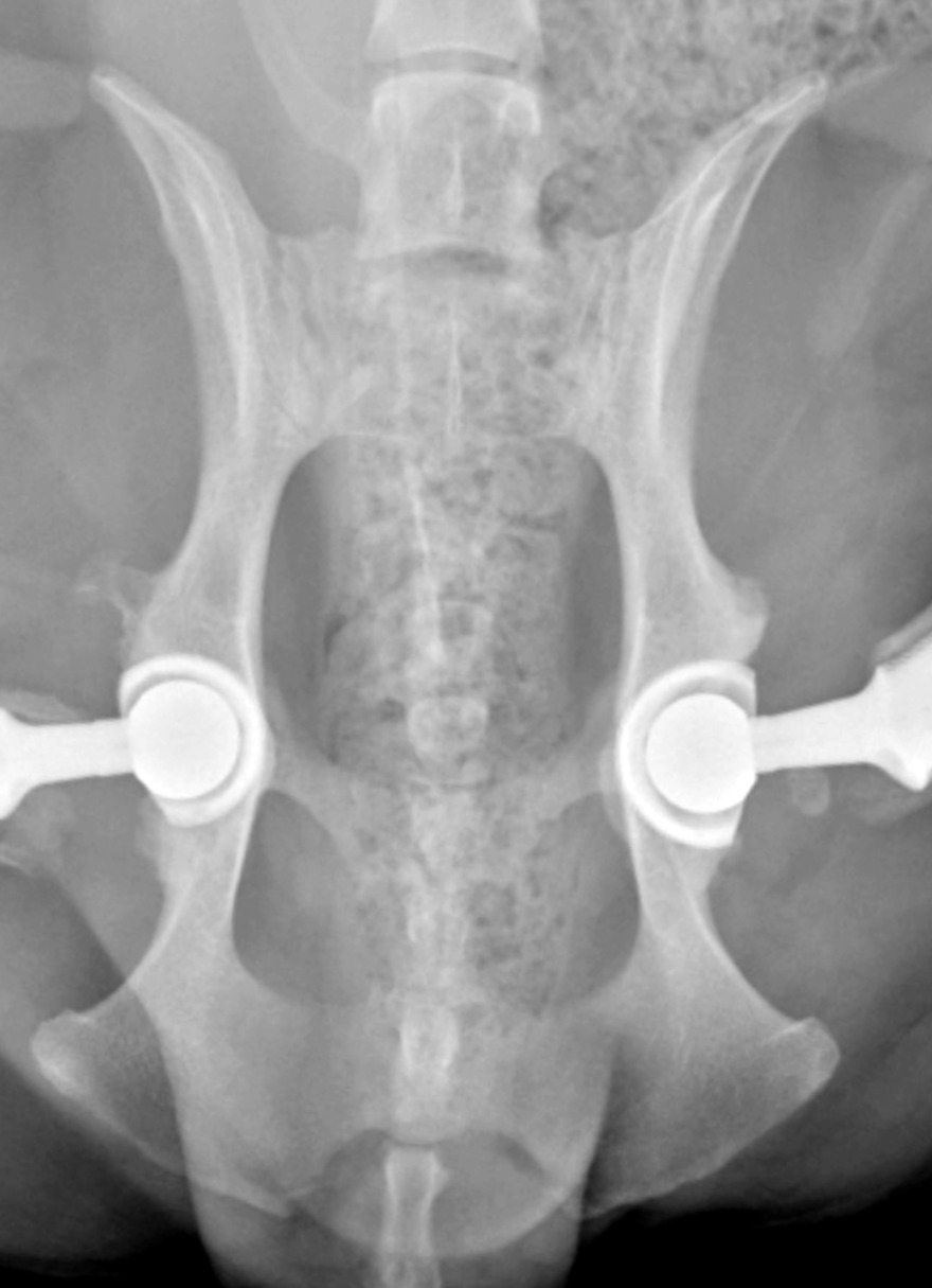 Postoperative radiograph showing bilateral total hip replacements